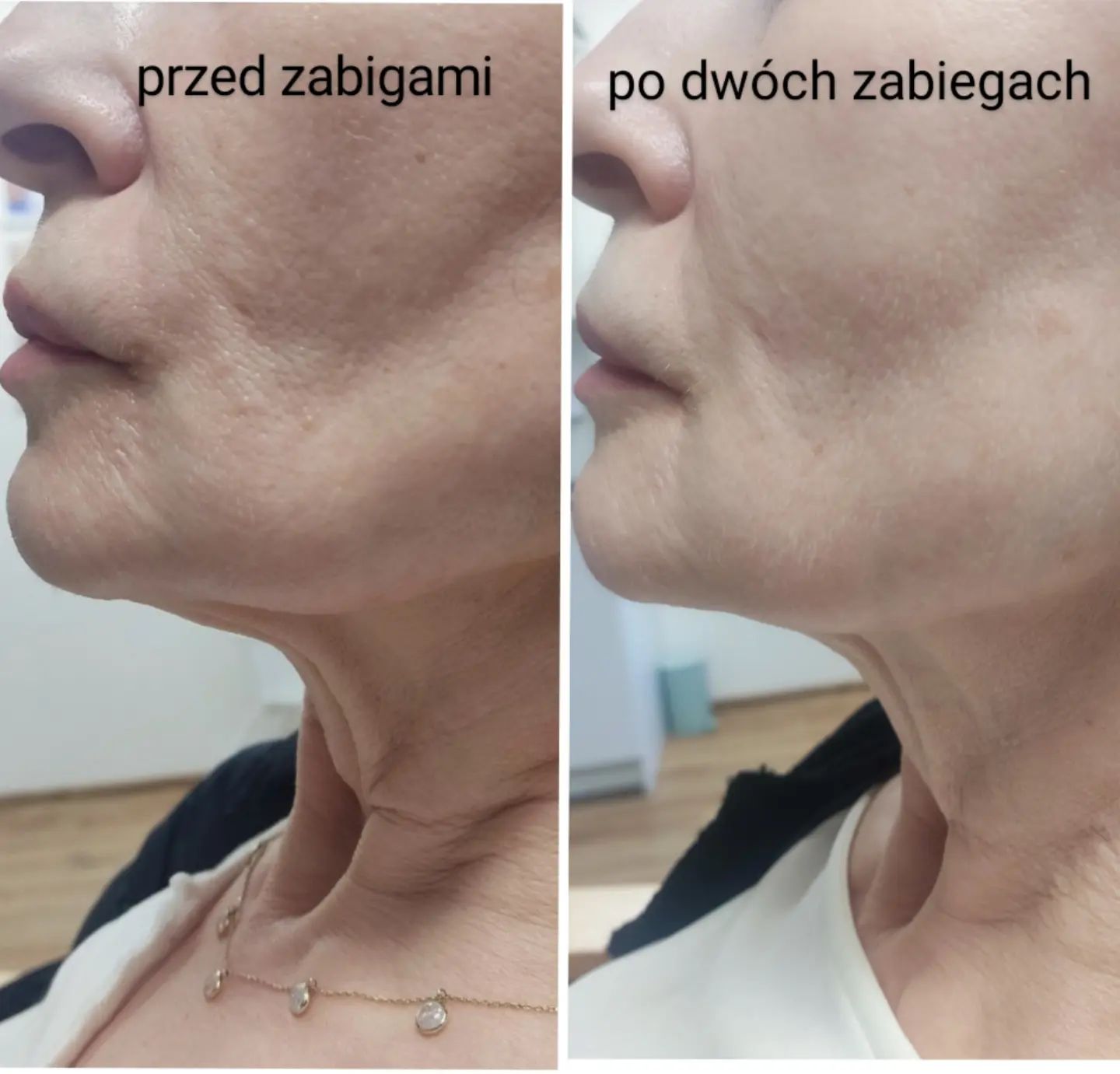 Efekt widoczny po dwóch zabiegach radiofrekwencji mikroigłowej