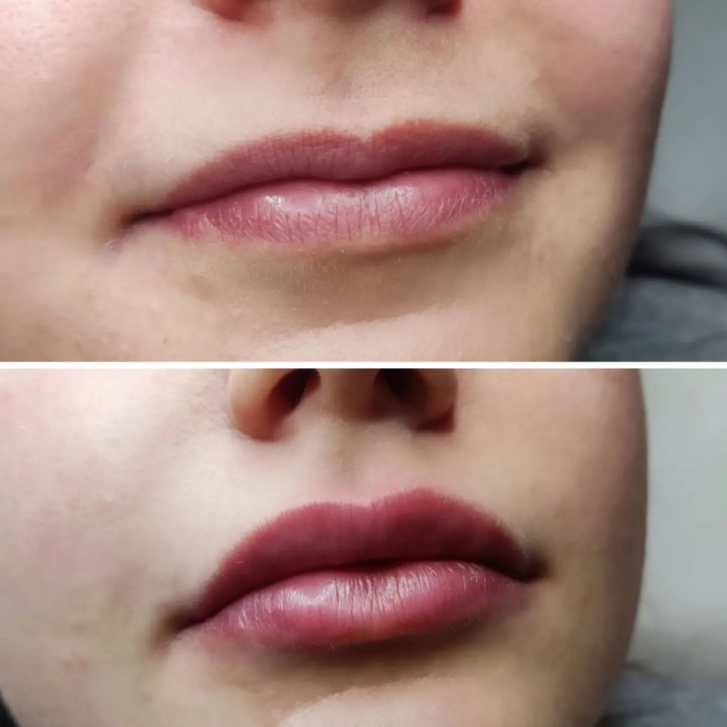 delikatne i naturalne powiększenie ust Efekt po zabiegu powiększenia ust kwasem hialuronowym